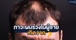 alopecia androgenic