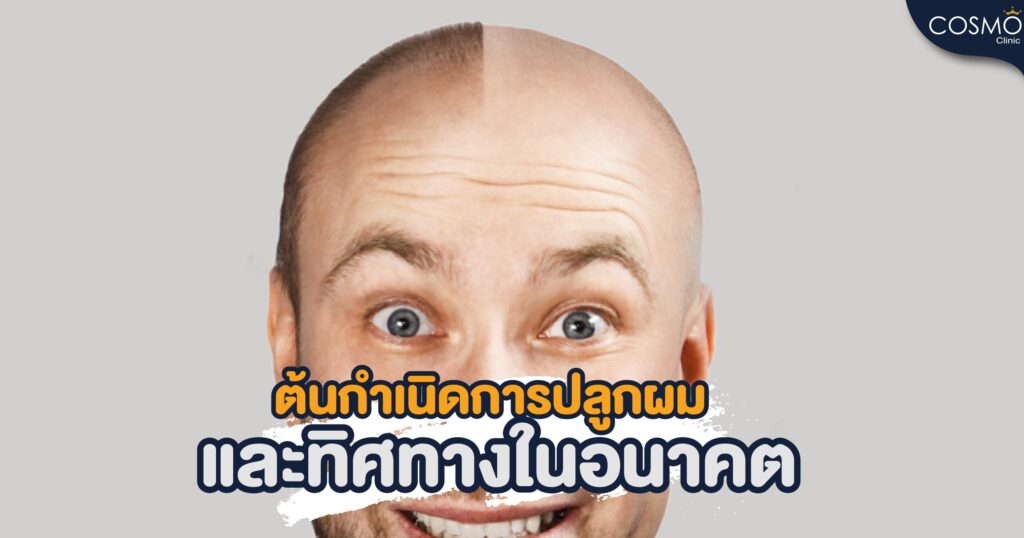 hidtory of hair transplant