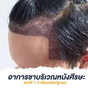 ปลูกผม