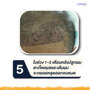 ปลูกผม