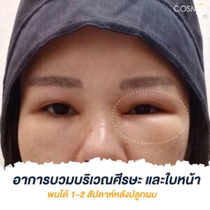 ปลูกผม