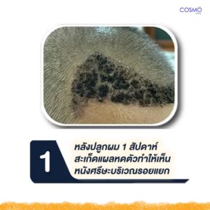 ปลูกผม