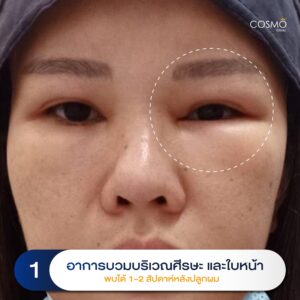 ปลูกผม