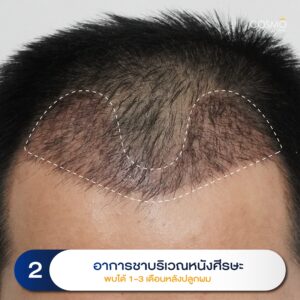 ปลูกผม