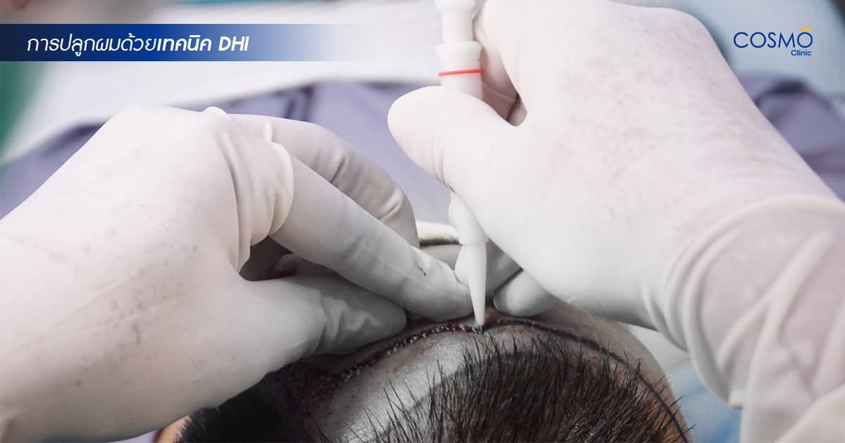 Discover Direct Hair Implantation (DHI)