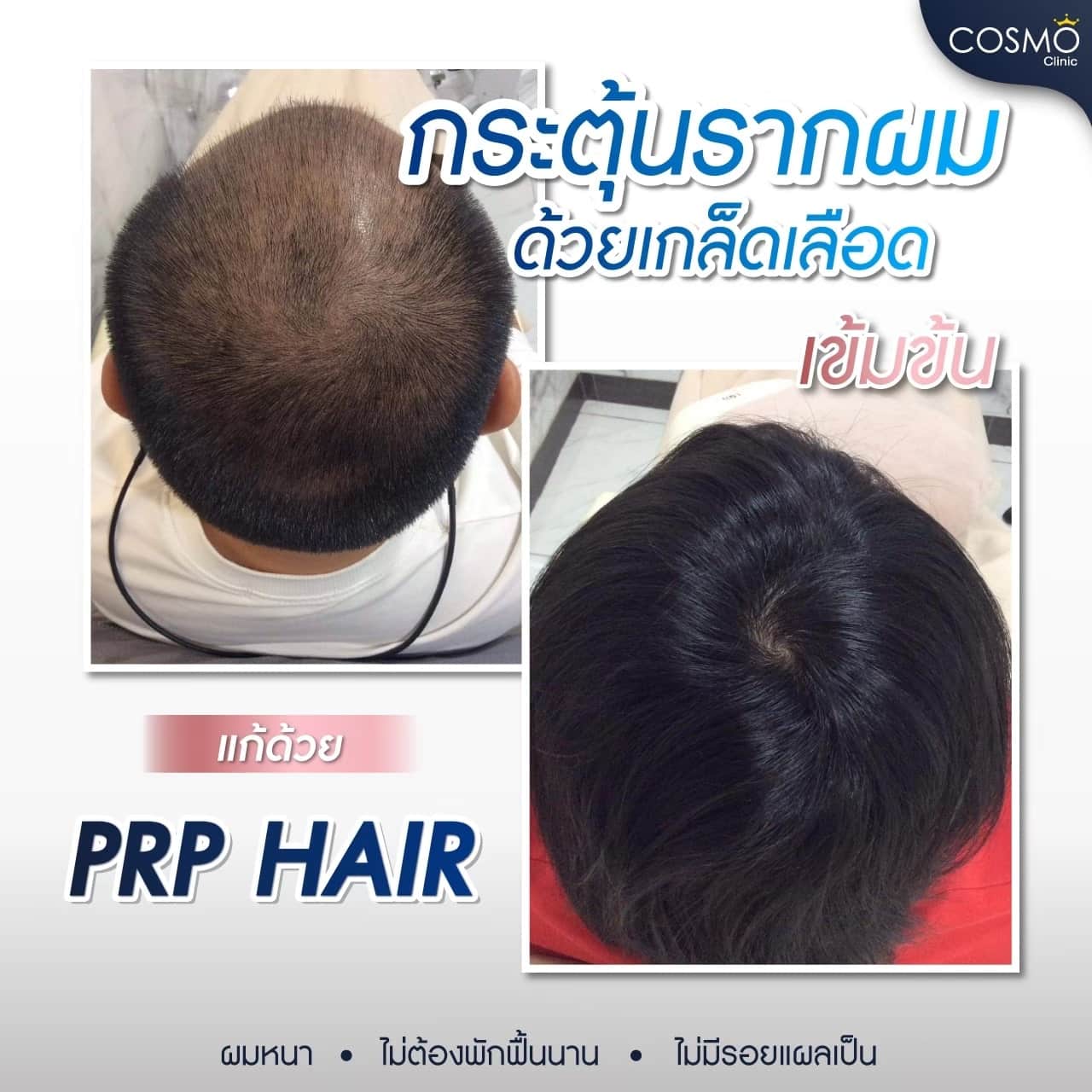 Understanding Platelet-Rich Plasma for Hair Restoration