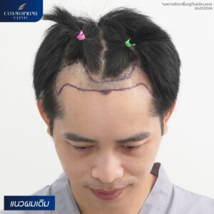 Best hair transplant in Bangkok price