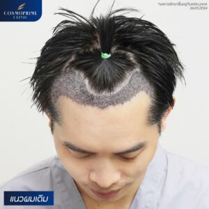 thailand hair transplant package