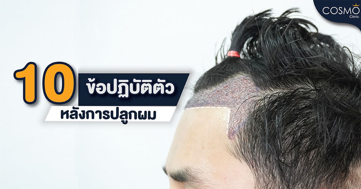 10 ข้อปฏิบัติตัวหลังการปลูกผม ความรู้ปลูกผม