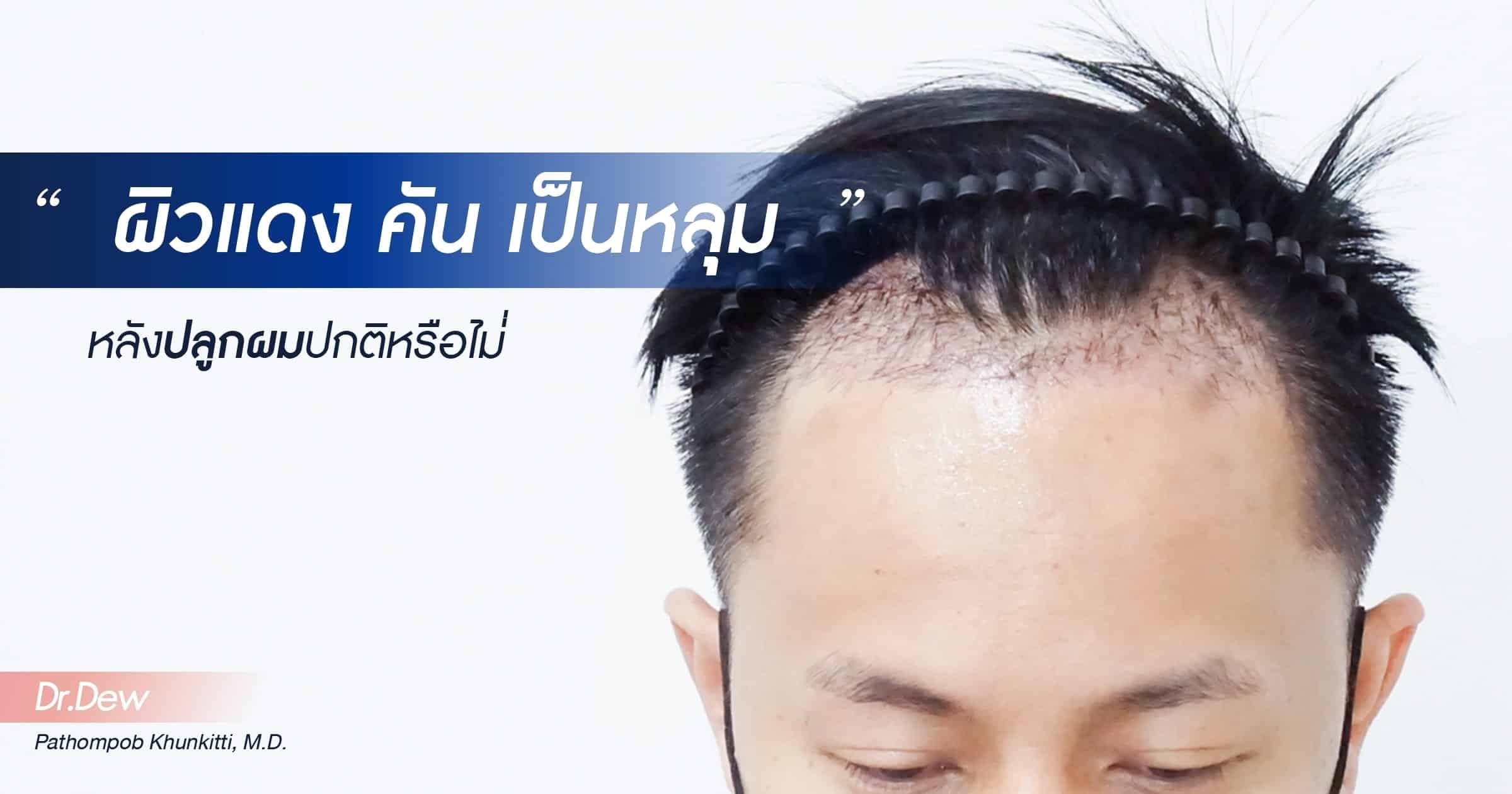 ผิวแดง คัน เป็นหลุม หลังปลูกผม ปกติหรือไม่ | Cosmo Hair Center