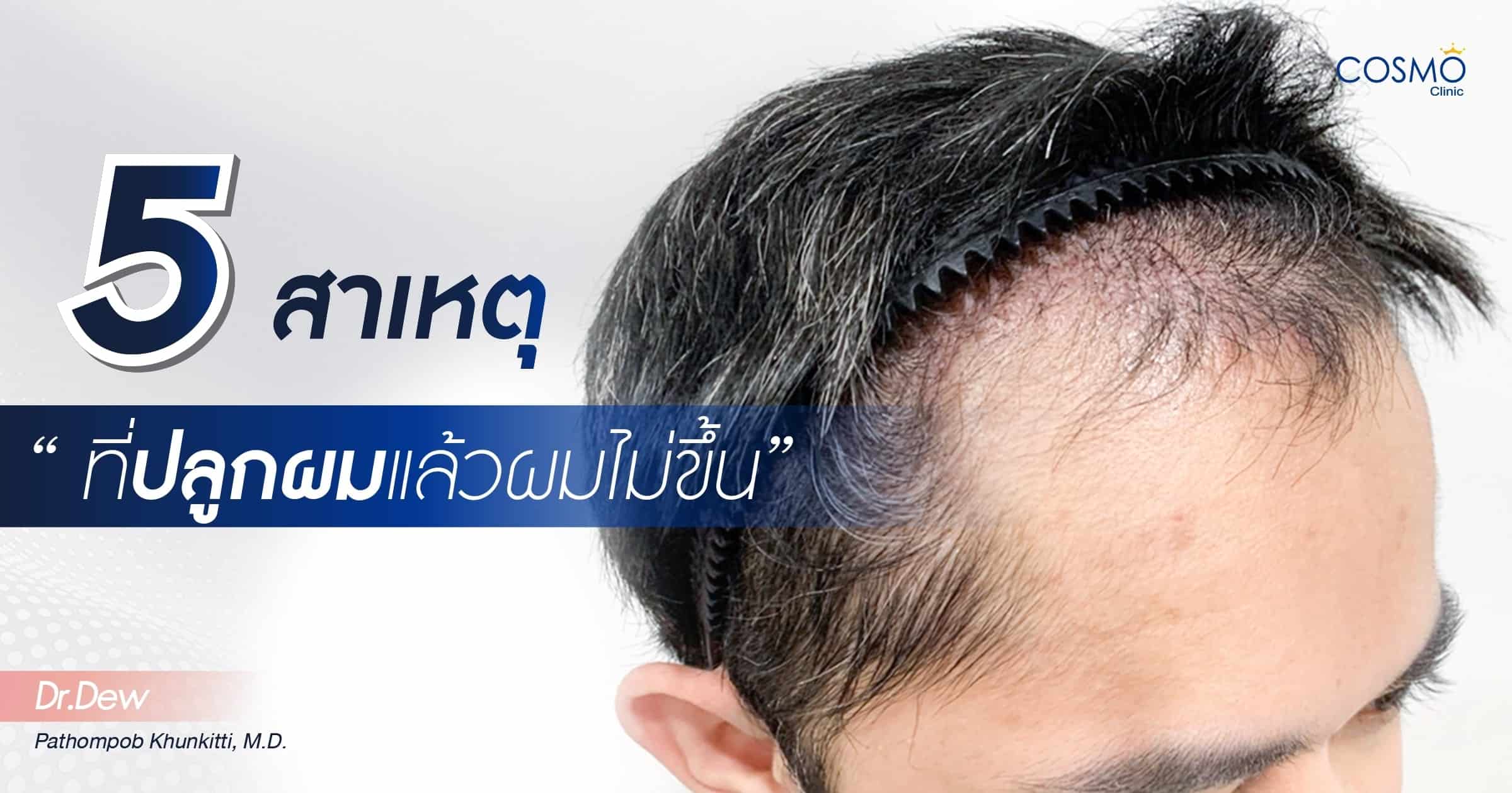 5 สาเหตุที่ปลูกผมแล้วไม่ขึ้น | Cosmo Hair Center