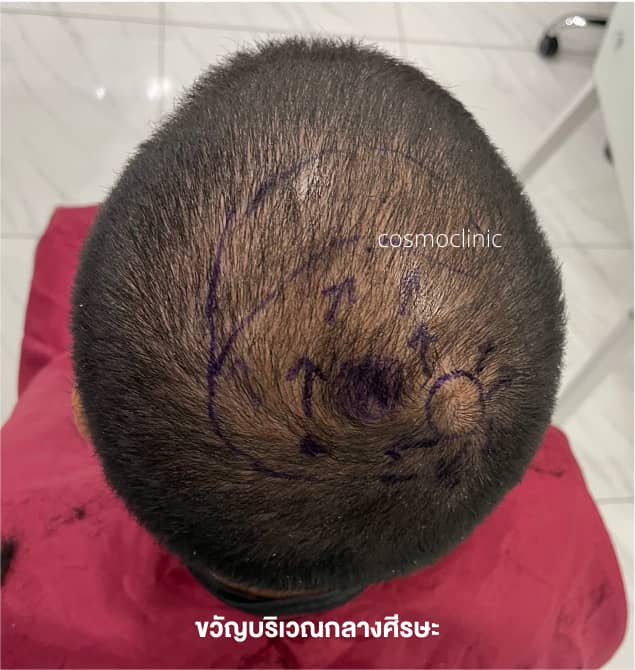 ทิศทางของเส้นผม จุดไหนที่ควรสังเกตและให้ความสำคัญ – Cosmo Hair Center