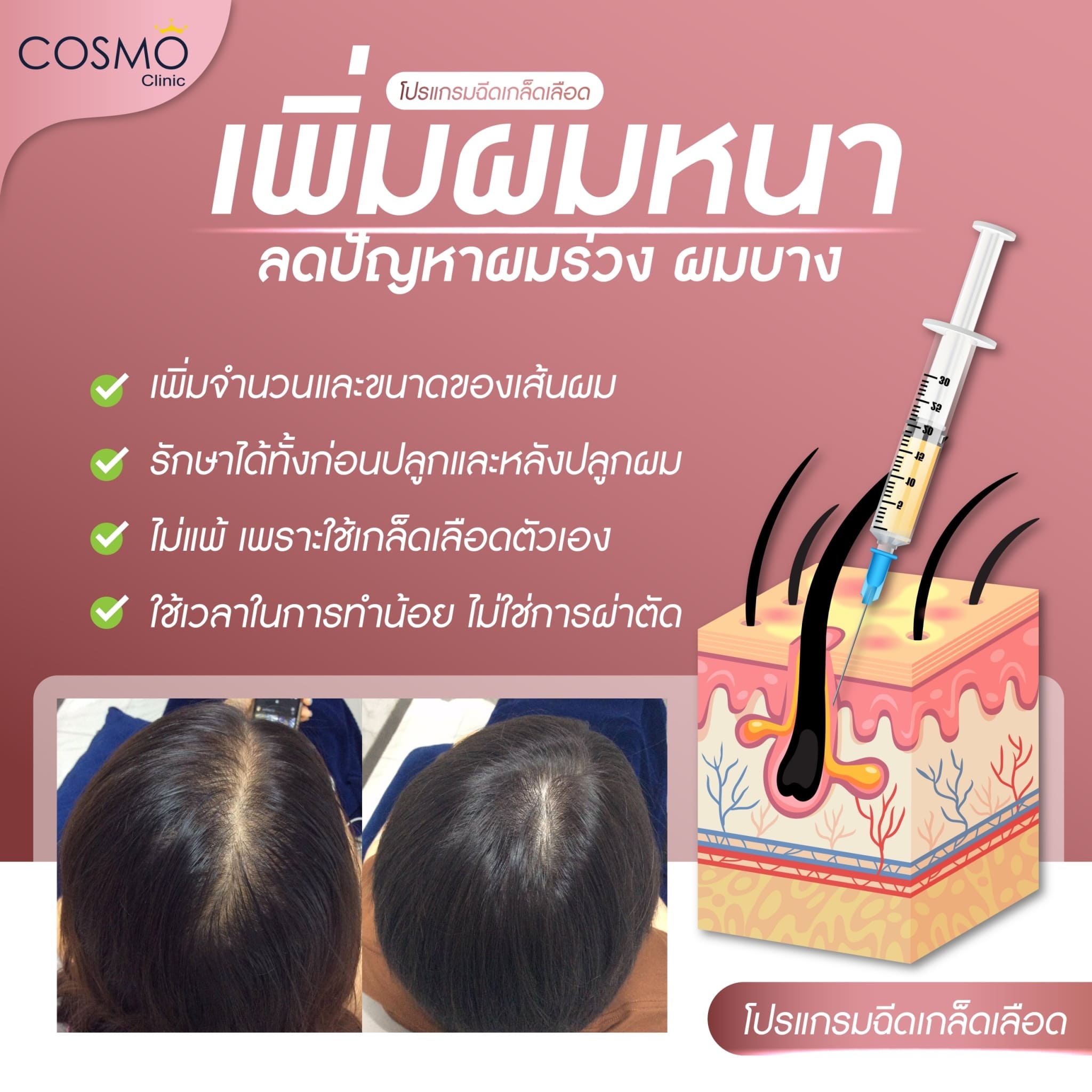 รีวิว หลังฉีด prp ผม