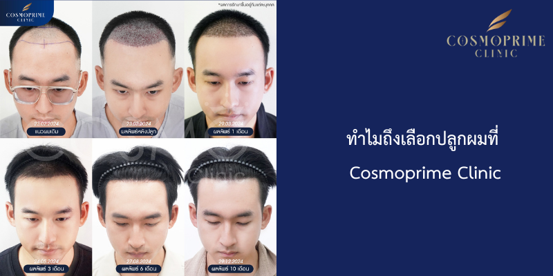 ทำไมถึงเลือกปลูกผมที่ Cosmoprime Clinic?