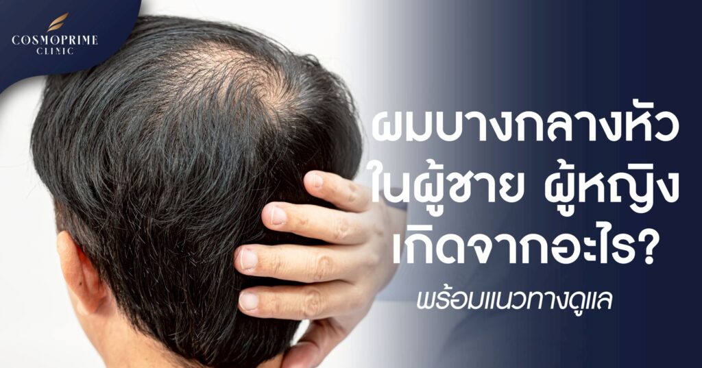 ผมบางกลางหัว