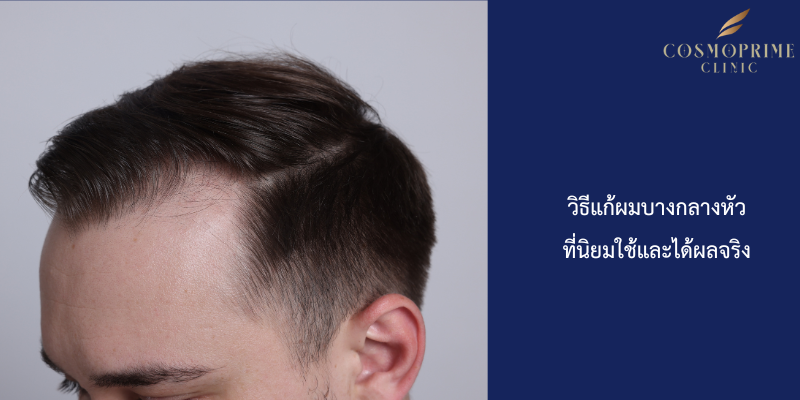 วิธีแก้ผมบางกลางหัวที่นิยมใช้และได้ผลจริง