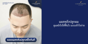 แผลหลังปลูกผม