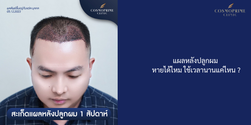 แผลหลังปลูกผม หายได้ไหม ใช้เวลานานแค่ไหน