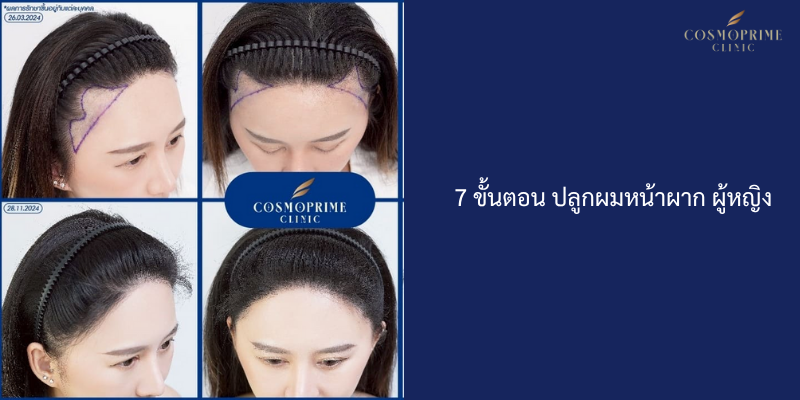 7ขั้นตอน ปลูกผมหน้าผาก ผู้หญิง